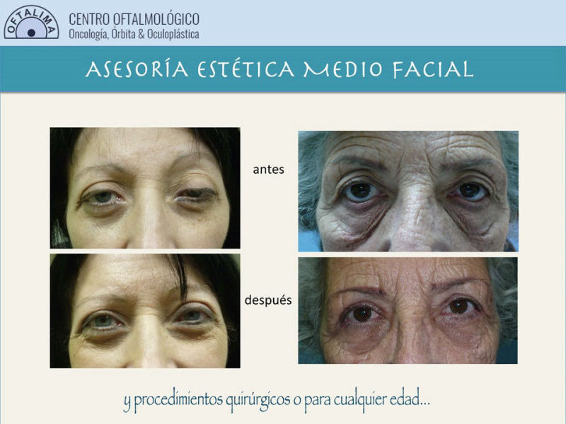 Oculoplastia_Oculoplastica_cirugia