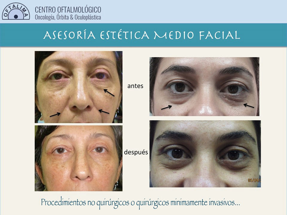Cirugia_oculoplastica_oculoplastia_lima